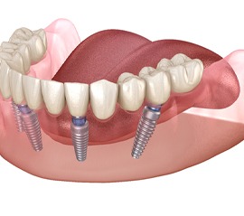 A digital image of an All-on-4 denture being placed on the lower arch and secured to four dental implants