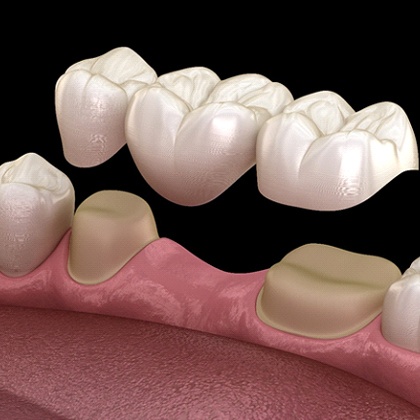 computer illustration of a dental bridge in Fargo being placed in a mouth