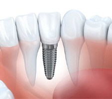 single dental implant (for missing one tooth section)