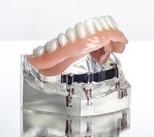 A denture designed to attach to dental implants in Fargo