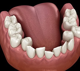 Illustration of crooked teeth