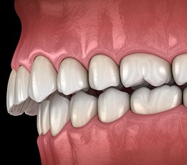 Illustration of an overbite