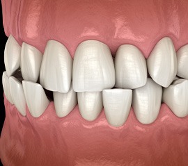 Illustration of a crossbite