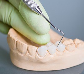 Model smile with fixed bridge restoration