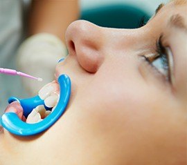 Patient receiving fluoride treatment