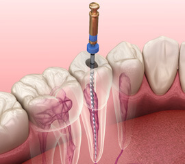 someone getting a dentla crown