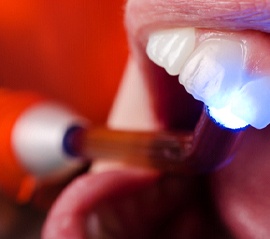 Dental bonding procedure