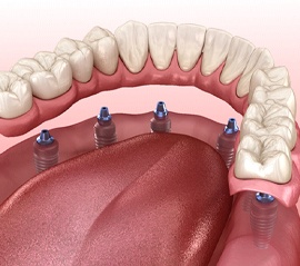 Illustration of implant denture supported by six implants
