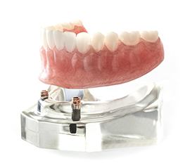 Model of All-on-4 denture