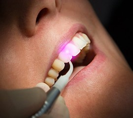 Close up of a dentist using a soft tissue laser on a patient’s gumline