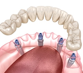 Illustration of implant denture for lower arch against white background