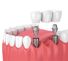 implant bridge 