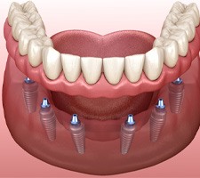 implant dentures  