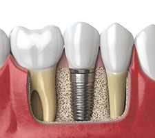 Render of a dental implant in Fargo, ND