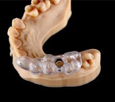 a guided dental implant system on a model of teeth