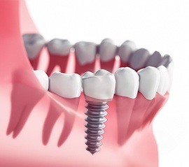 Diagram of an integrated dental implant in Fargo