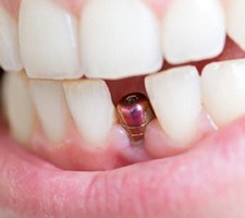 Closeup of mouth with an integrated dental implant in Fargo