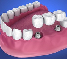 Diagram of bridge floating over integrated dental implants in Fargo