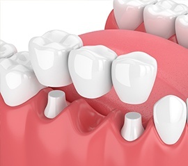 Animation of dental bridge placement