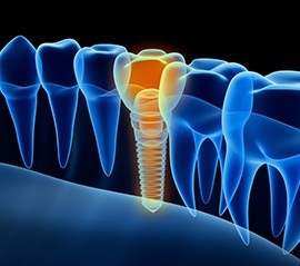 Animation of implant supported dental crown