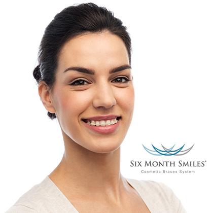 Woman with six month smiles braces