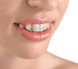 Closeup of teeth with six month smiles braces