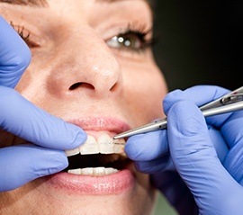 Closeup of dentist placing six month smiles braces