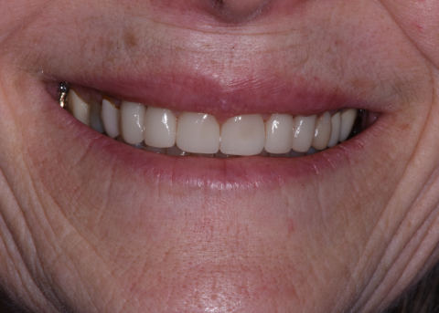smile after