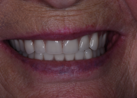 smile after