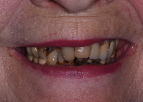 smile before