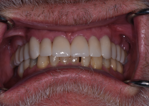 smile after