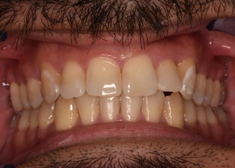smile after