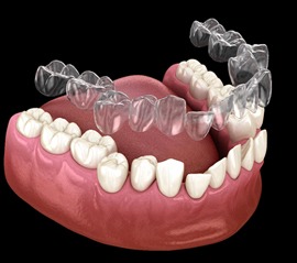 Illustration of SureSmile being used to correct crooked teeth