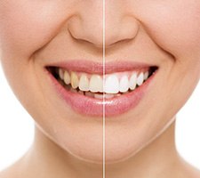 Before and after of a teeth whitening treatment