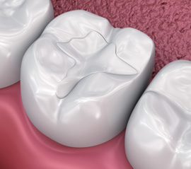 A 3D illustration of tooth-colored fillings