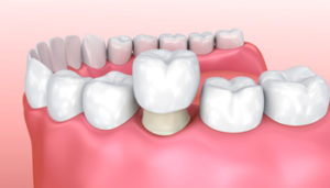 dental-crowns