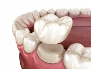 Illustration of same-day crown in Fargo being placed on tooth