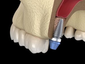 Model showing the basics of dental implants.