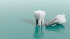 Image of a molar and dental implants