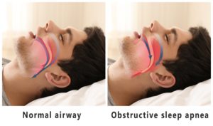 Comparison of normal and sleep apnea airways