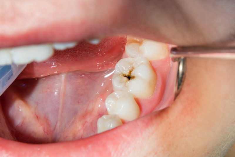 closeup of someone with a cavity
