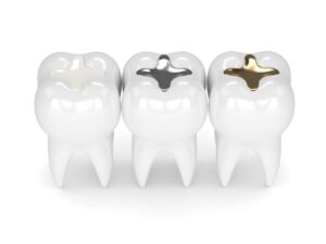 Tooth fillings.