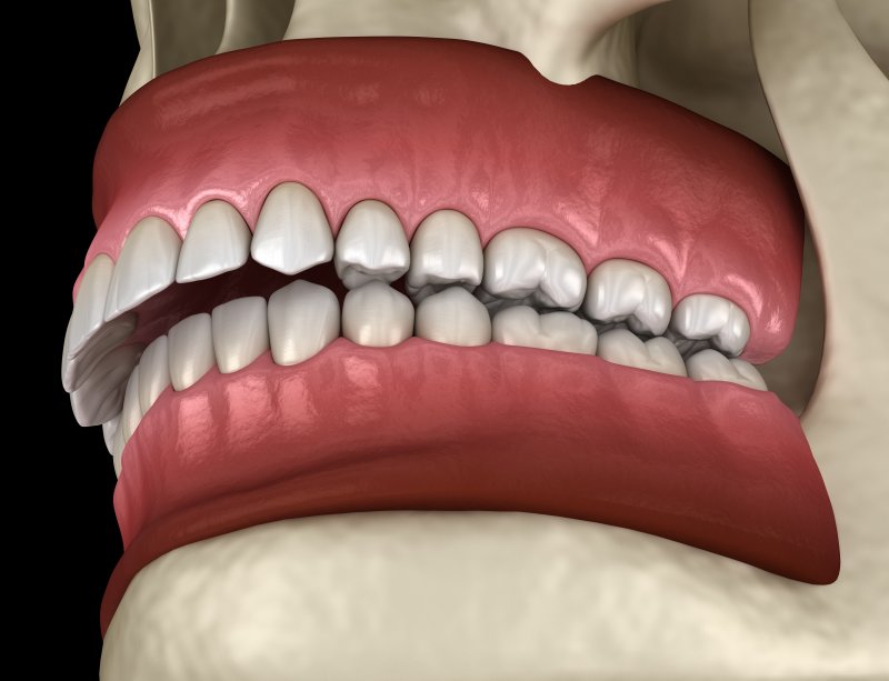 digital image of a severe overbite