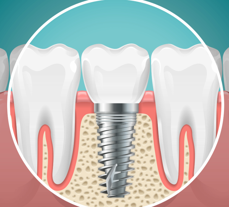 Illustrated cross section of a dental implant