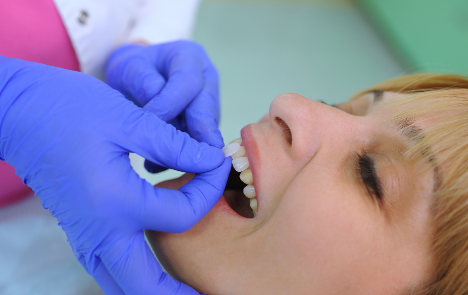 Dentist fitting veneers to patient